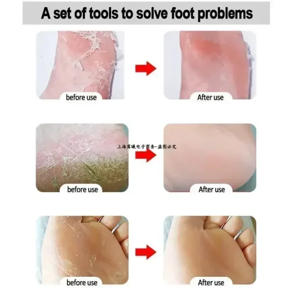 RHBJ 1Pcs Professional Stainless Steel Callus Remover Hand Foot File Scraper Pedicure Tools Dead Skin Remove for Heels Feet Care - Image 2