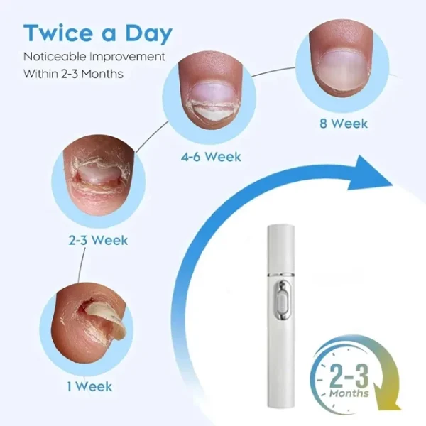 Nail Fungus Laser Device Fungal Nail Treatment Repair Onychomycosis Toenail Fingernail Removes Pedicure Foot Care Fungi Ingrown - Image 2